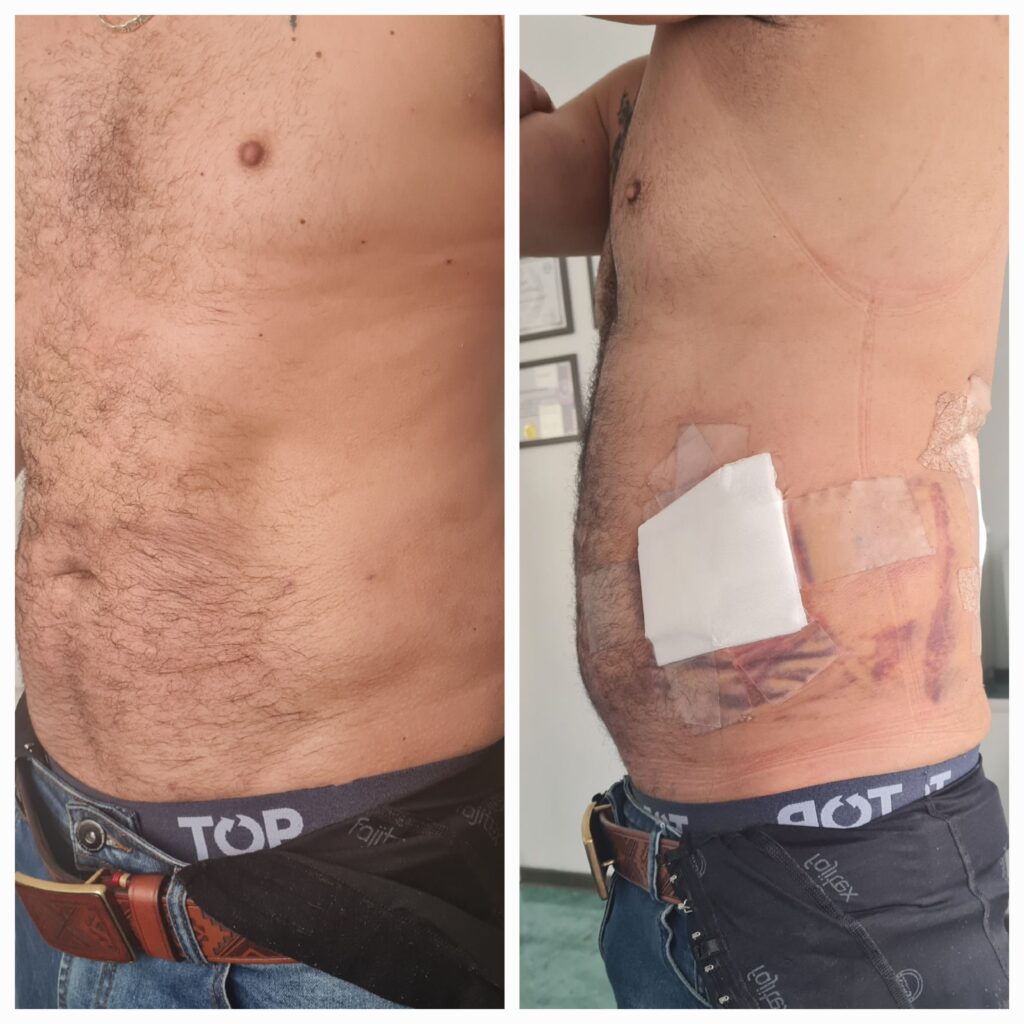 Antes / Después — Tratamiento de Fibrosis Postquirúrgica