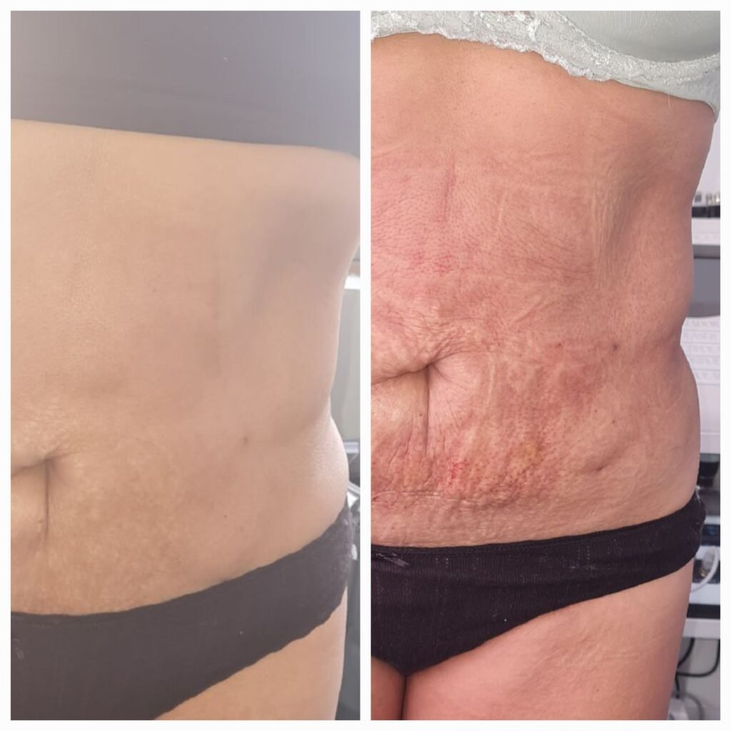 Antes / Después — Tratamiento de Fibrosis Postquirúrgica