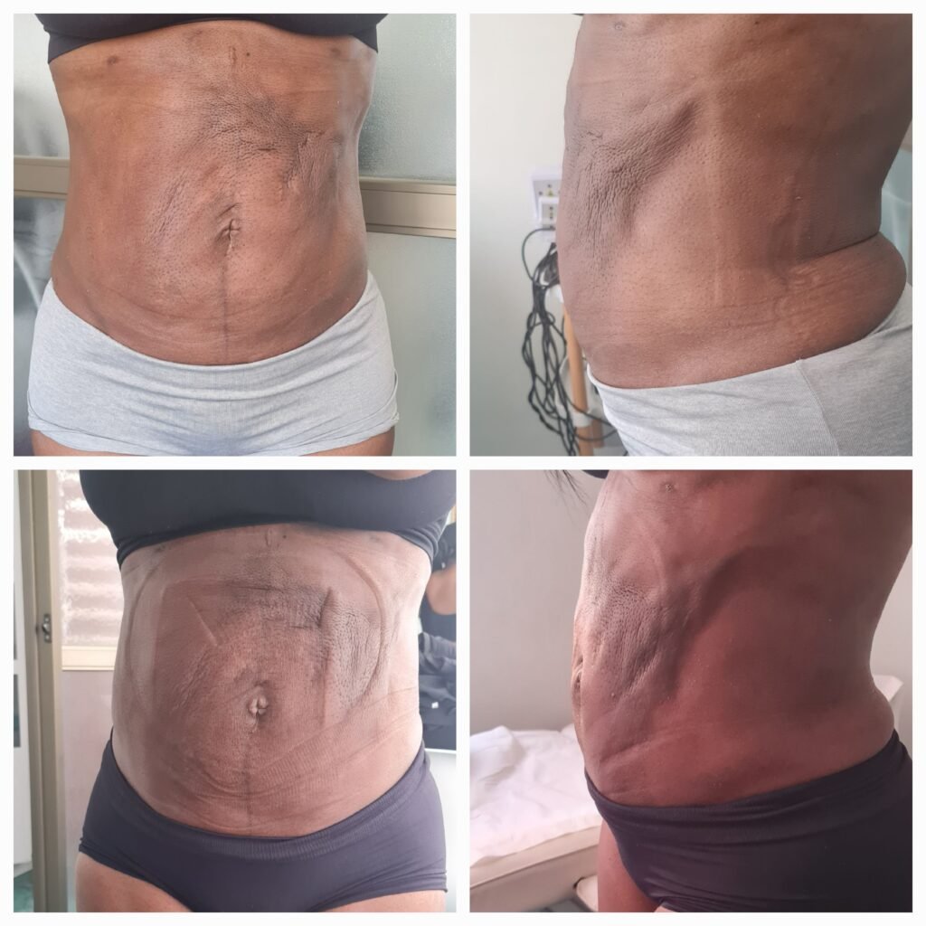 Antes / Después — Tratamiento de Fibrosis Postquirúrgica