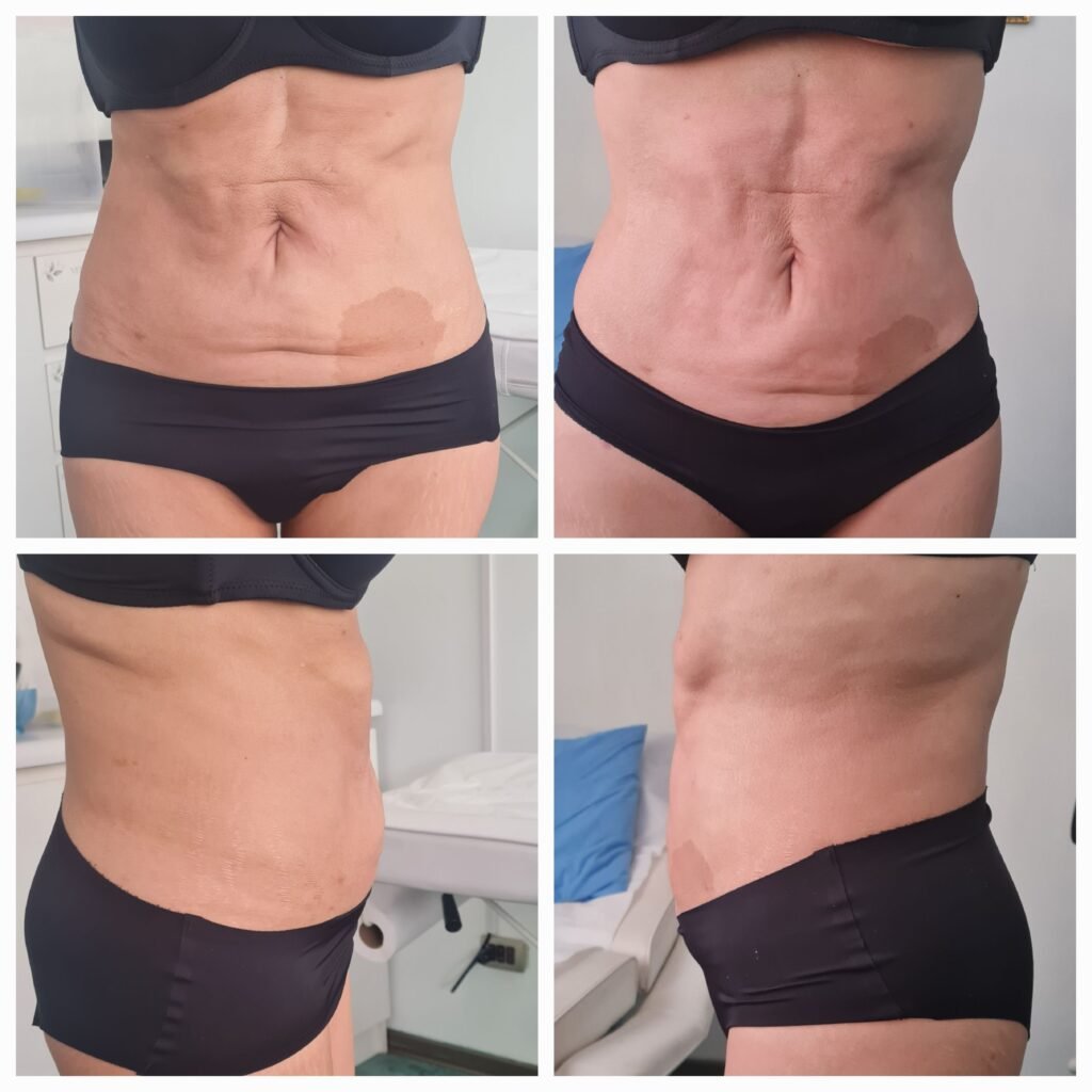 Antes / Después — Tratamiento de Fibrosis Postquirúrgica