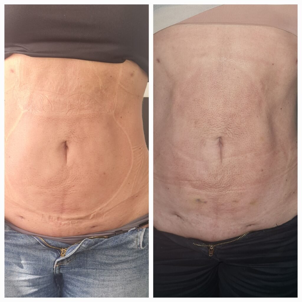 Antes / Después — Tratamiento de Fibrosis Postquirúrgica