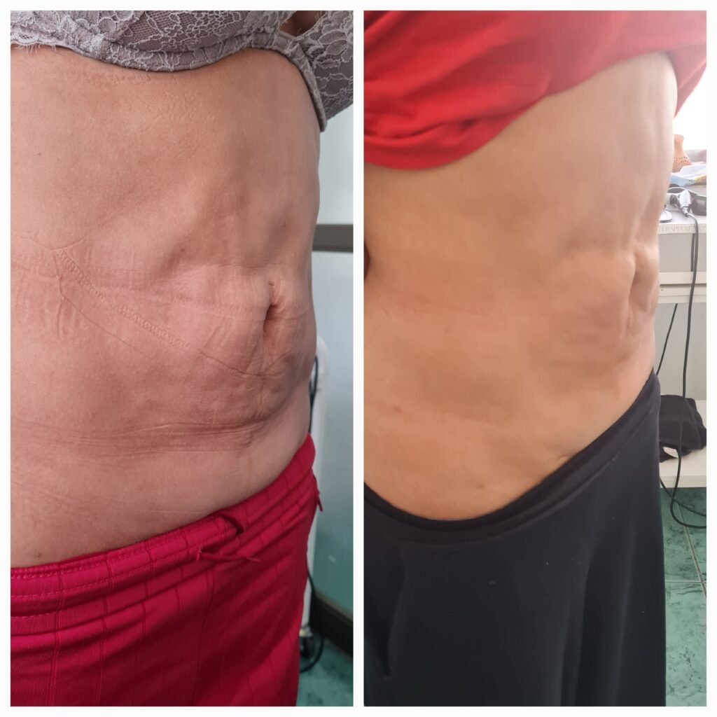 Antes / Después — Tratamiento de Fibrosis Postquirúrgica