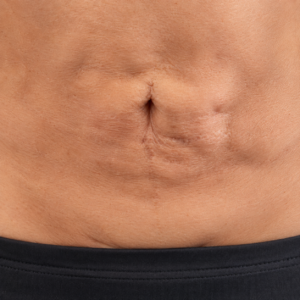 Tratamiento de Fibrosis Postquirúrgica