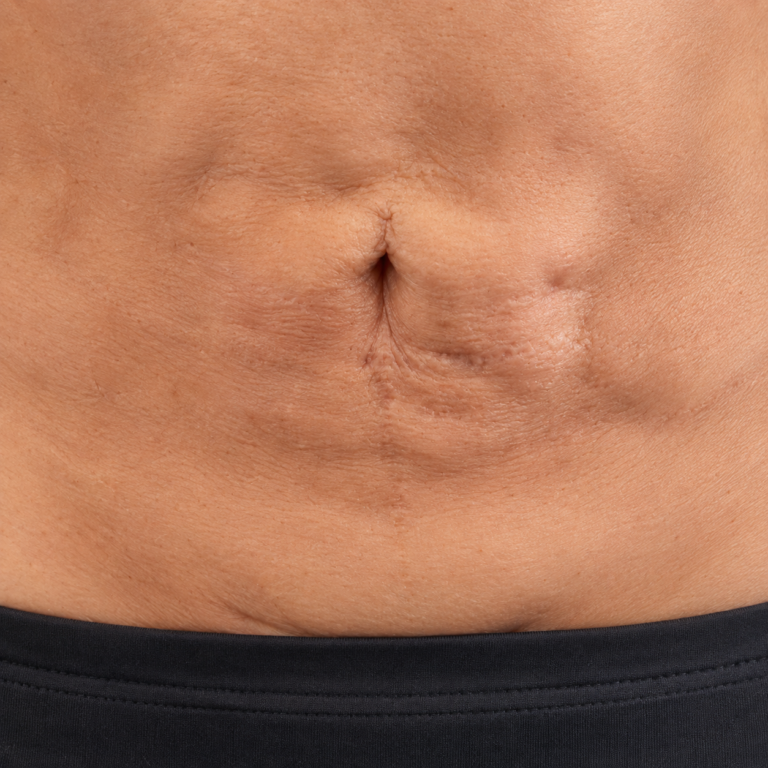Tratamiento de Fibrosis Postquirúrgica — Dermakinesic, Antofagasta