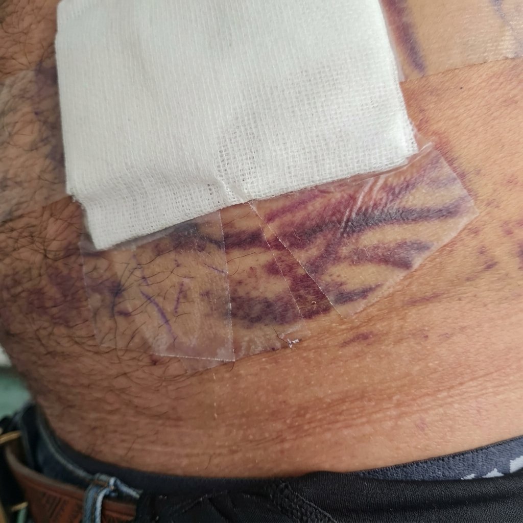 Tratamiento de Cicatrices