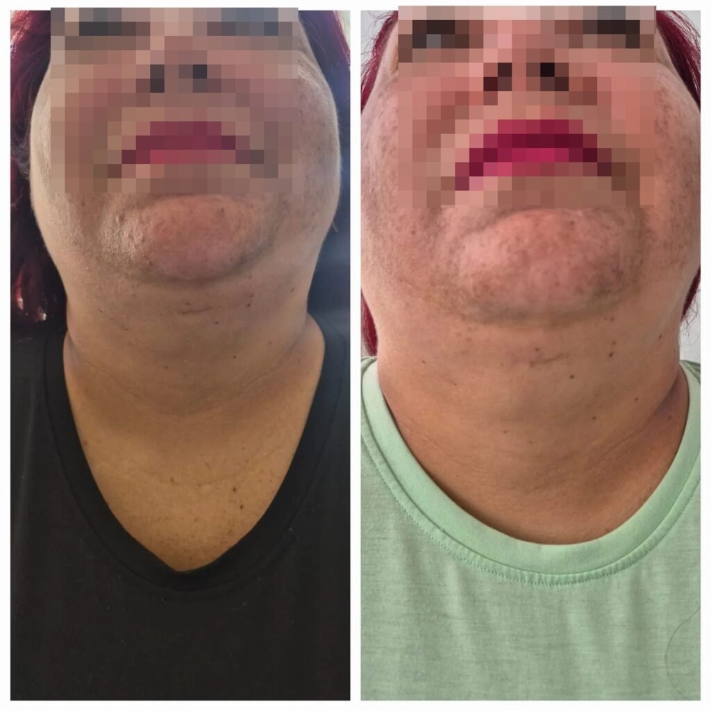 Antes / Después — Tratamiento de Lipedema y Linfedema