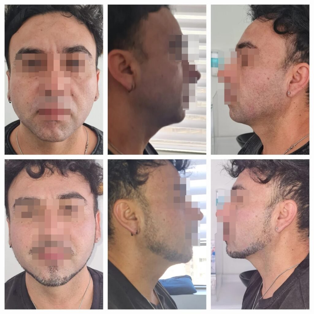Antes / Después — Tratamientos Reductivos y Reafirmantes