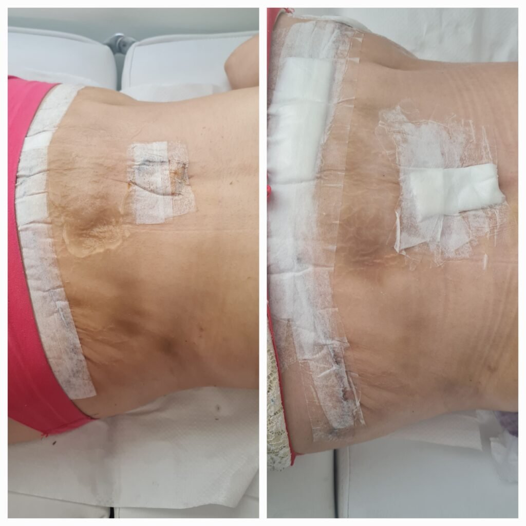 Antes / Después — Tratamiento de Cicatrices