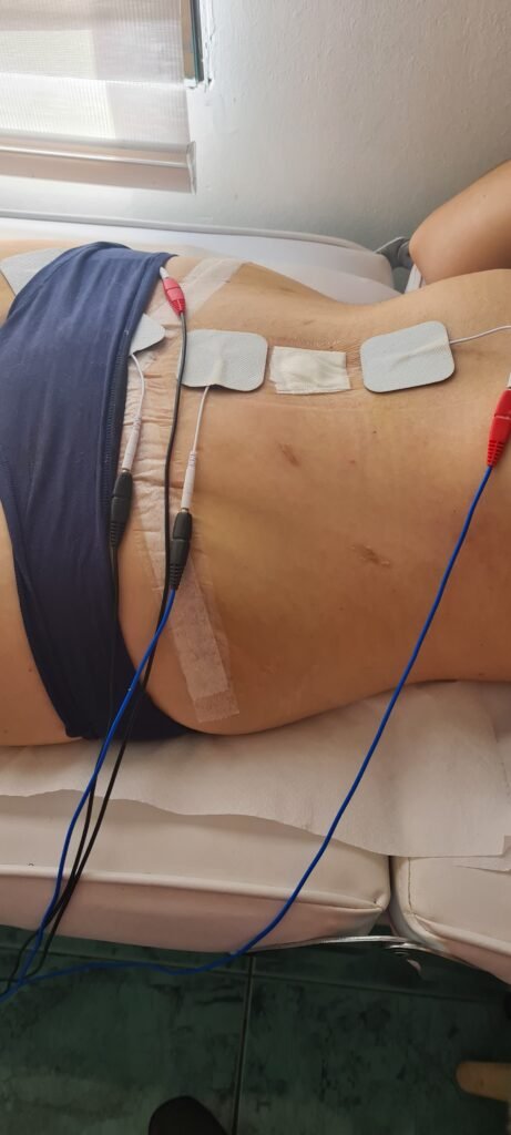 Tratamiento de Cicatrices