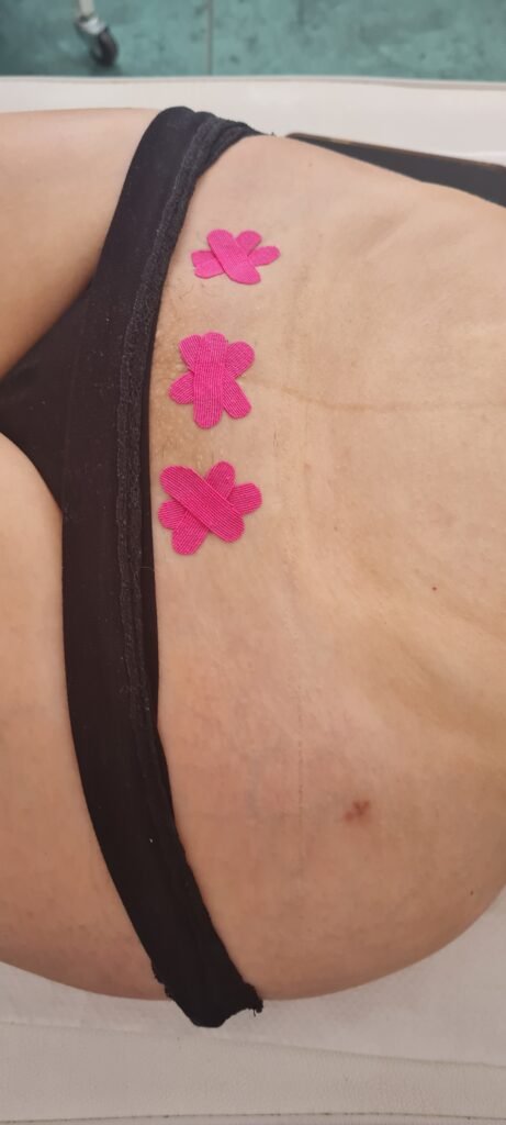 Tratamiento de Cicatrices