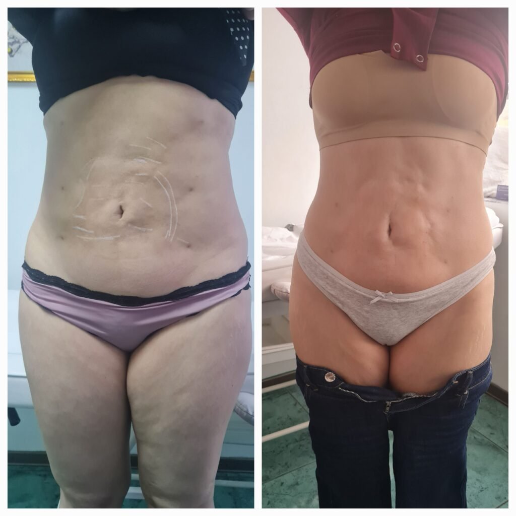 Antes / Después — Tratamiento de Fibrosis Postquirúrgica