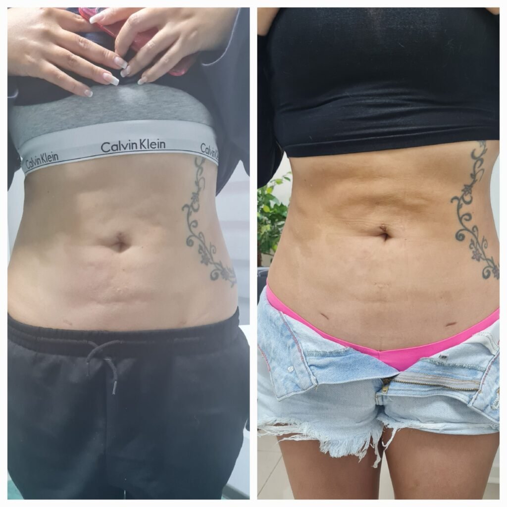 Antes / Después — Tratamiento de Fibrosis Postquirúrgica