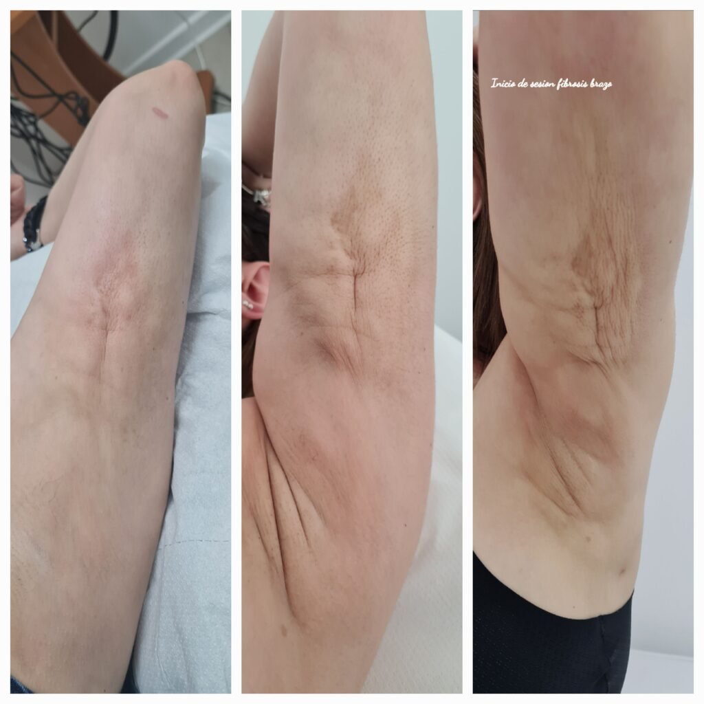 Antes / Después — Tratamiento de Fibrosis Postquirúrgica