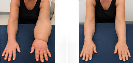 Antes / Después — Tratamiento de Lipedema y Linfedema