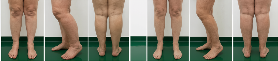 Antes / Después — Tratamiento de Lipedema y Linfedema